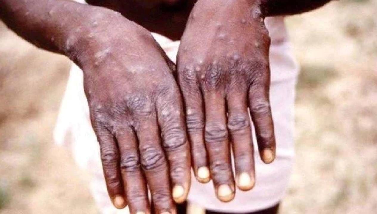 ganada m cicegi vaka sayisi 565e cikti mVhWLpAh